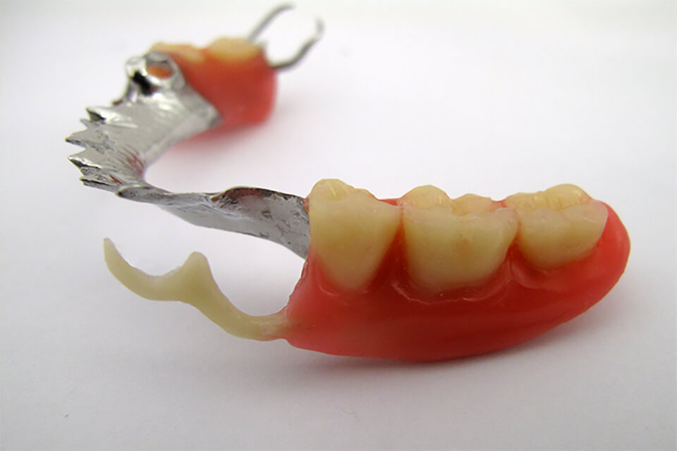 Parcial prótesis dental